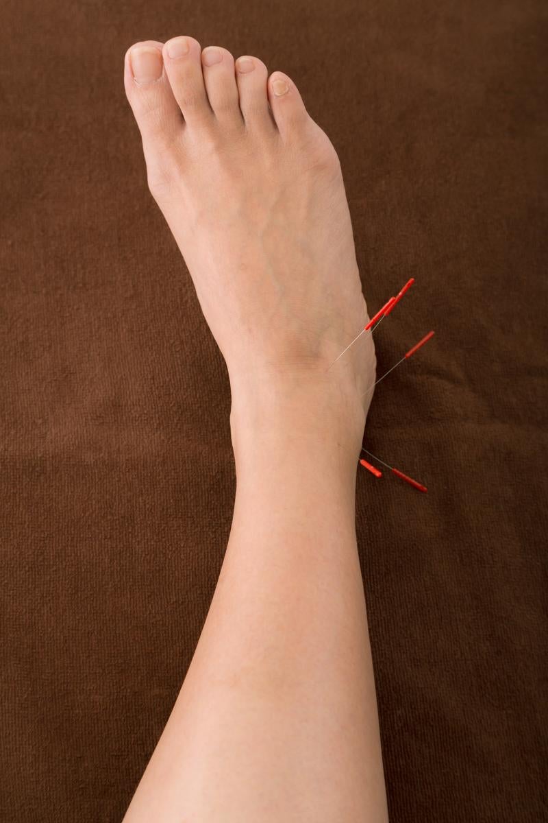 Swollen foot and ankle with acupuncture needles inserted during treatment